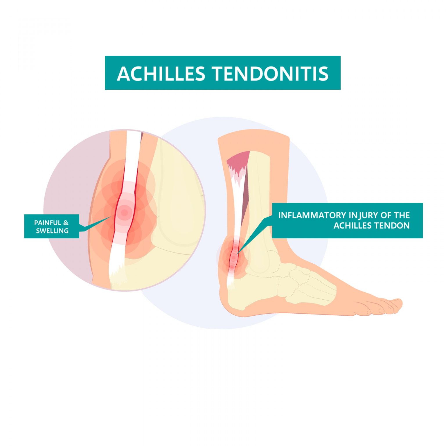 achilles tendonitis
