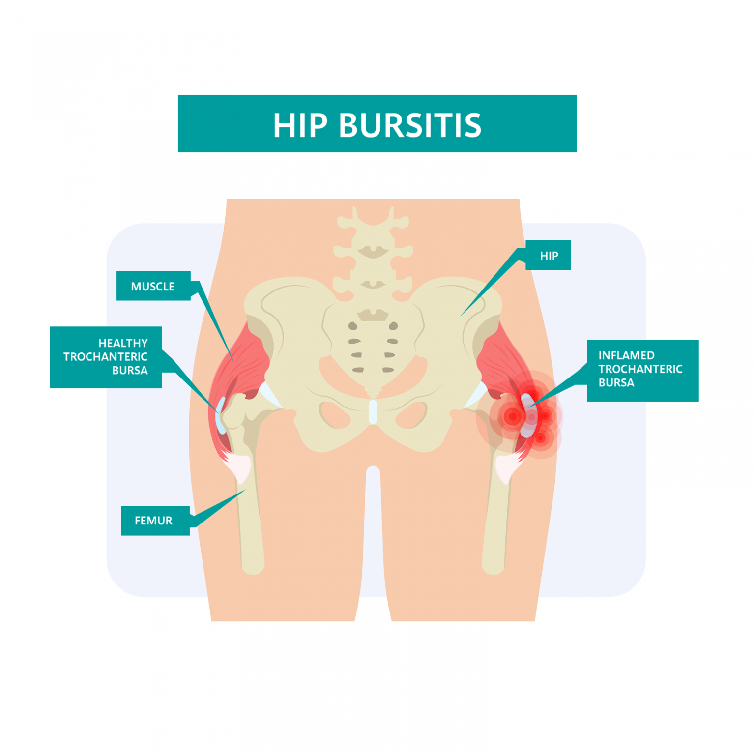 hip bursitis
