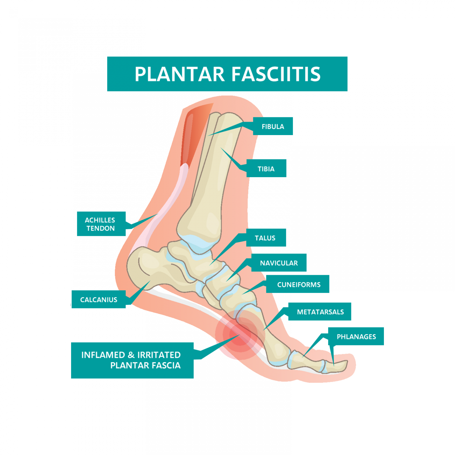 plantar fasciitis