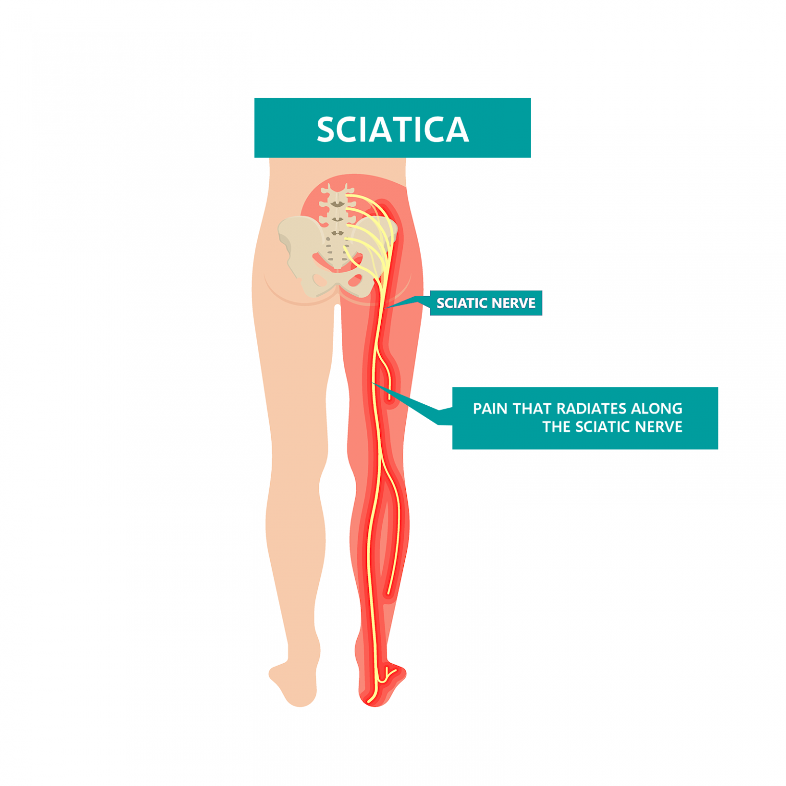 sciatica