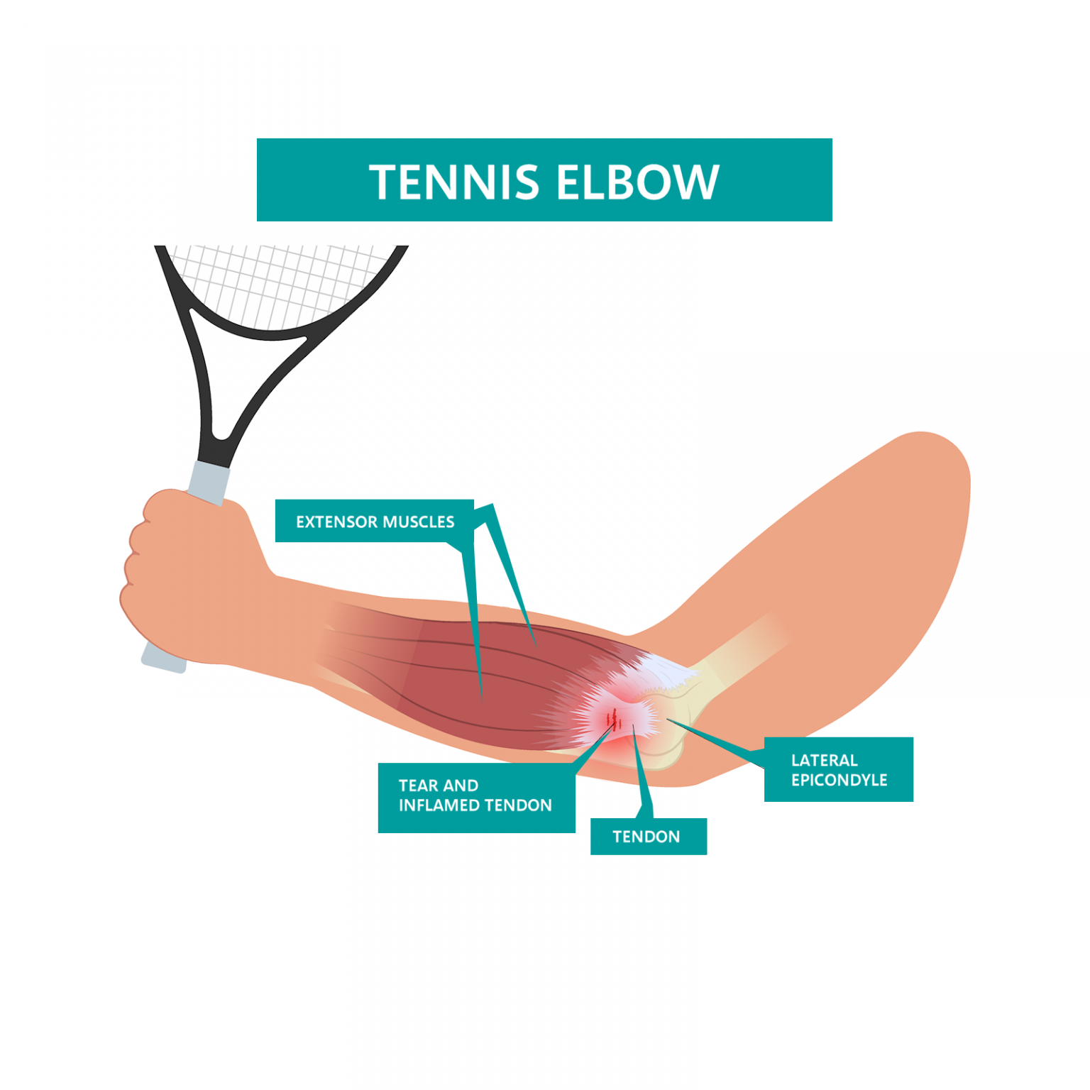 tennis elbow